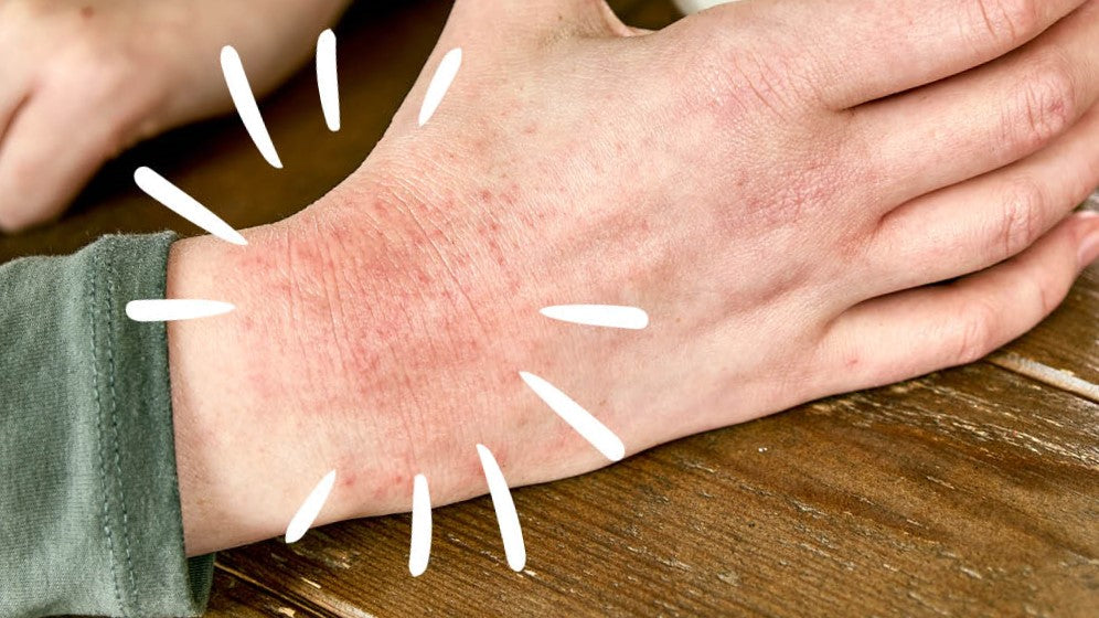 Dry Skin _Image of Eczema on Hand